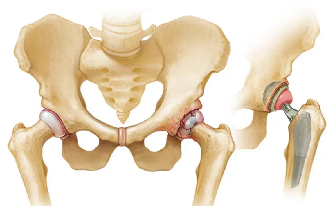 Hip Joint Replacement - Implant Components