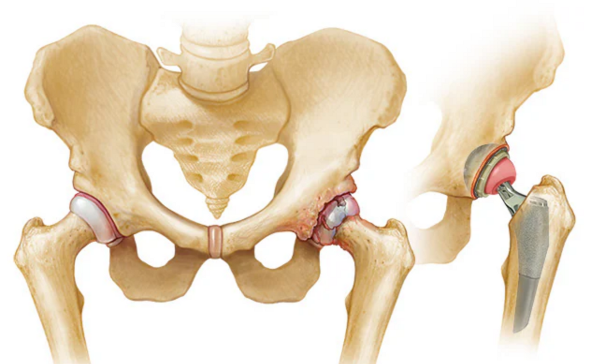 Hip Joint Replacement - Implant Components