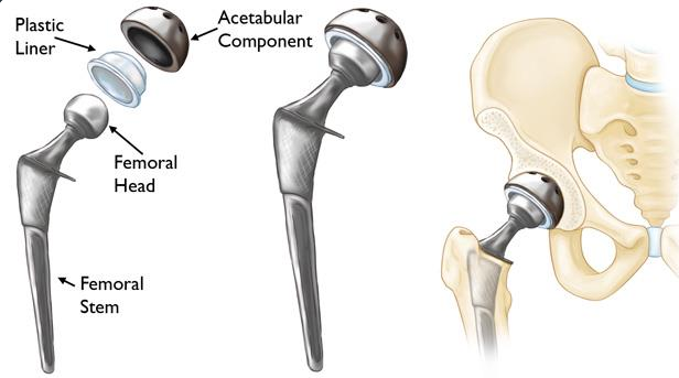 Hip Joint Replacement Surgery