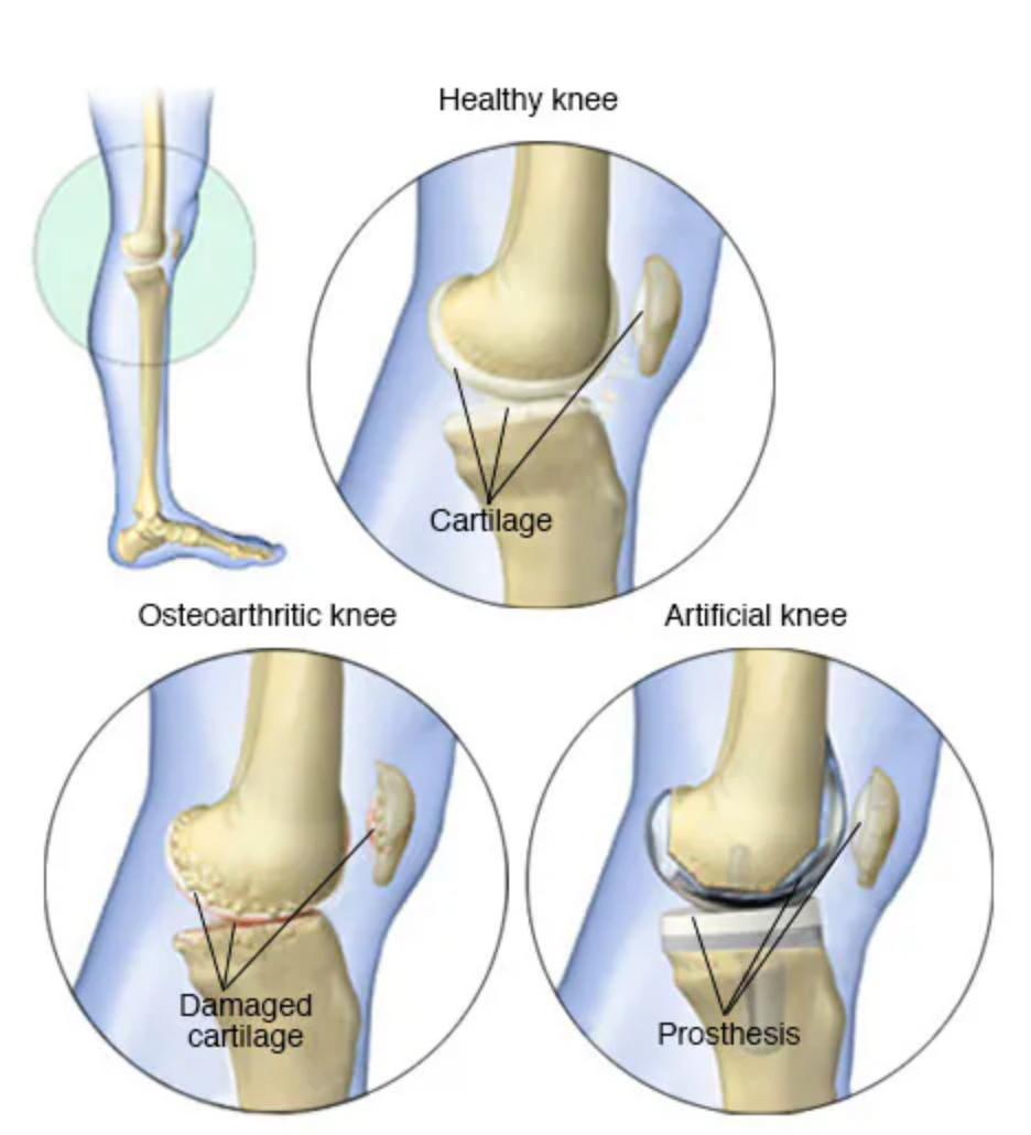 Knee Joint Replacement Surgery