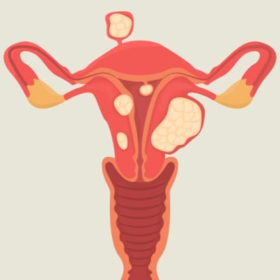 Uterine-Fibroids